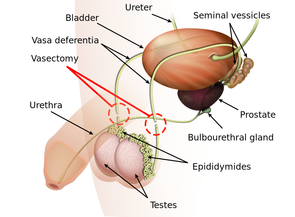 Vazektomie diagram