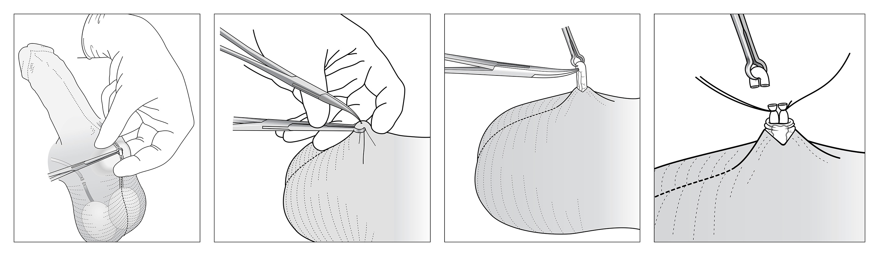 No scalpel vasectomy